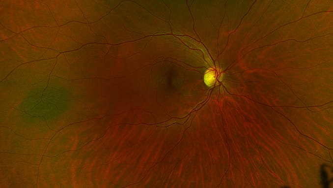 Retinal Nevus